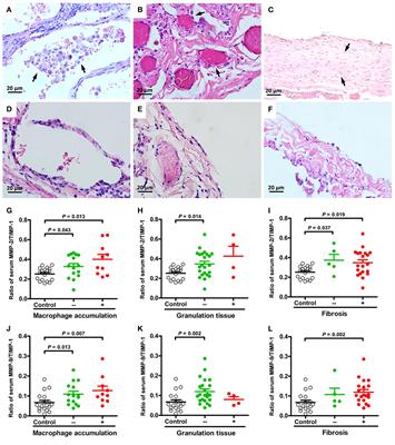 Histopathologic Findings Associated With Matrix Metalloproteinases Proceeding to Recurrence of Primary Spontaneous Pneumothorax in Adolescents